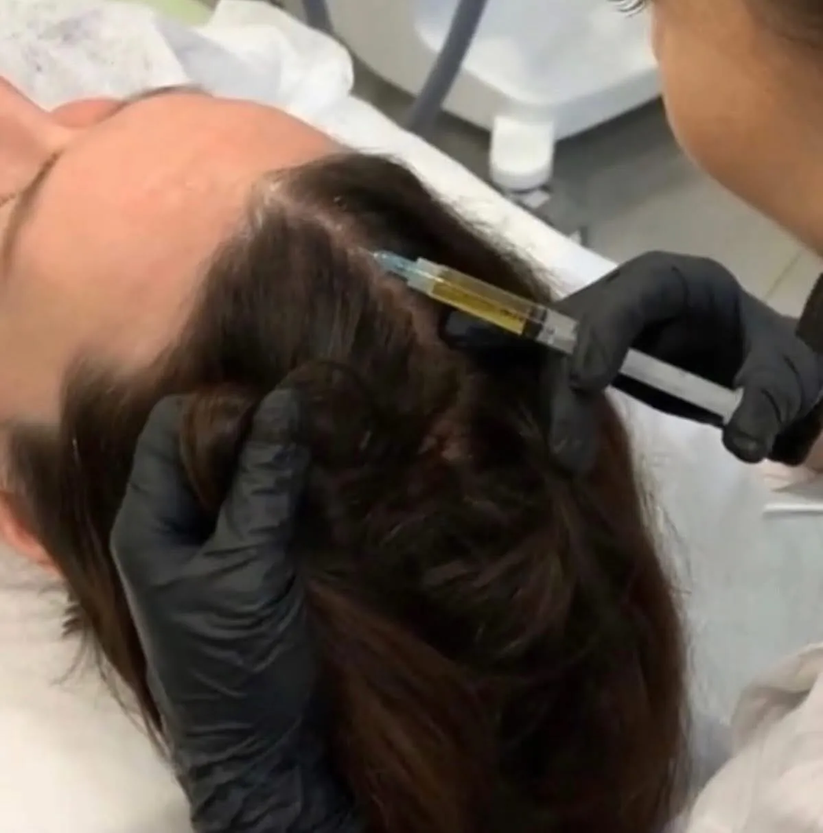 Zabieg mezoterapii skóry głowy w gabinecie w Warszawie Ursynów Kabaty